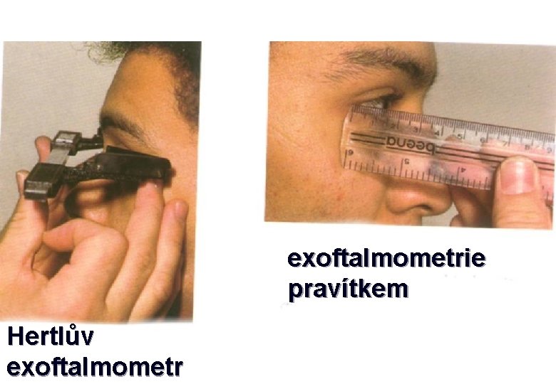 exoftalmometrie pravítkem Hertlův exoftalmometr 
