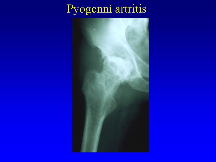 Pyogenní artritis 