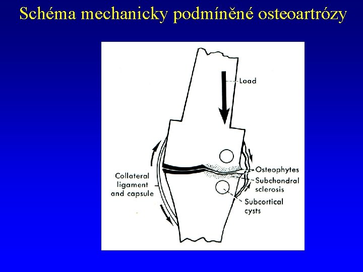 Schéma mechanicky podmíněné osteoartrózy 