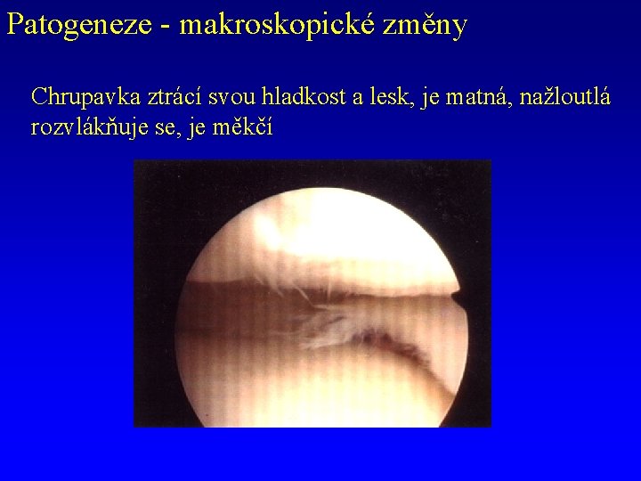 Patogeneze - makroskopické změny Chrupavka ztrácí svou hladkost a lesk, je matná, nažloutlá rozvlákňuje