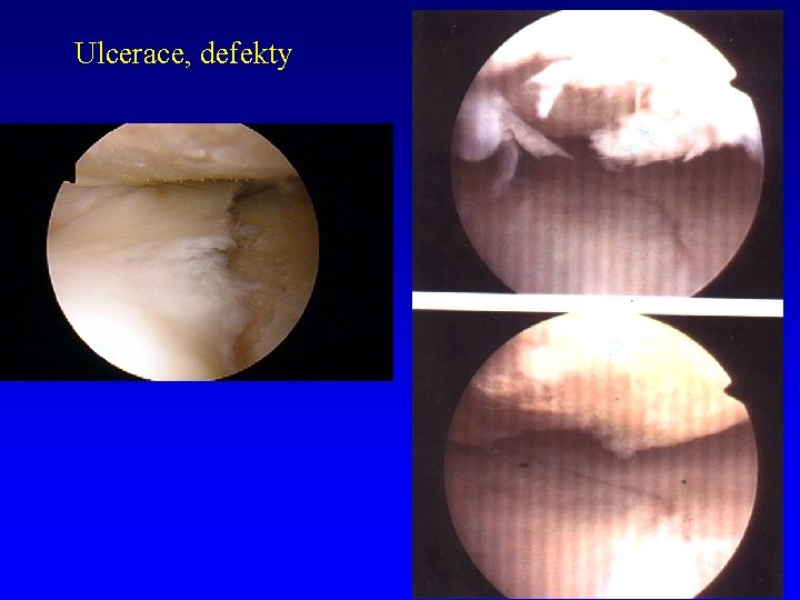 Ulcerace, defekty 