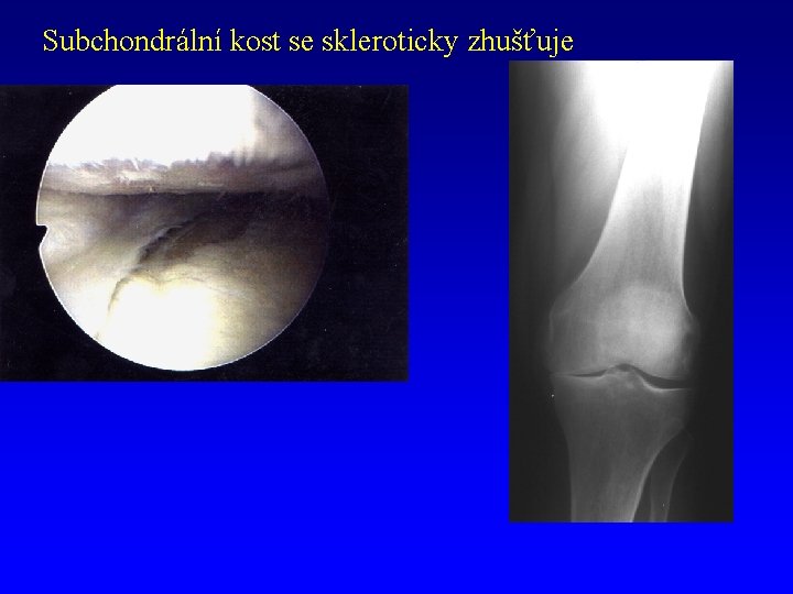 Subchondrální kost se skleroticky zhušťuje 