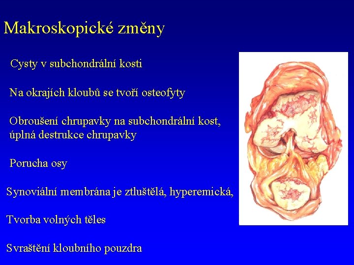 Makroskopické změny Cysty v subchondrální kosti Na okrajích kloubů se tvoří osteofyty Obroušení chrupavky