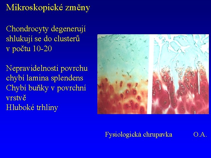 Mikroskopické změny Chondrocyty degenerují shlukují se do clusterů v počtu 10 -20 Nepravidelnosti povrchu