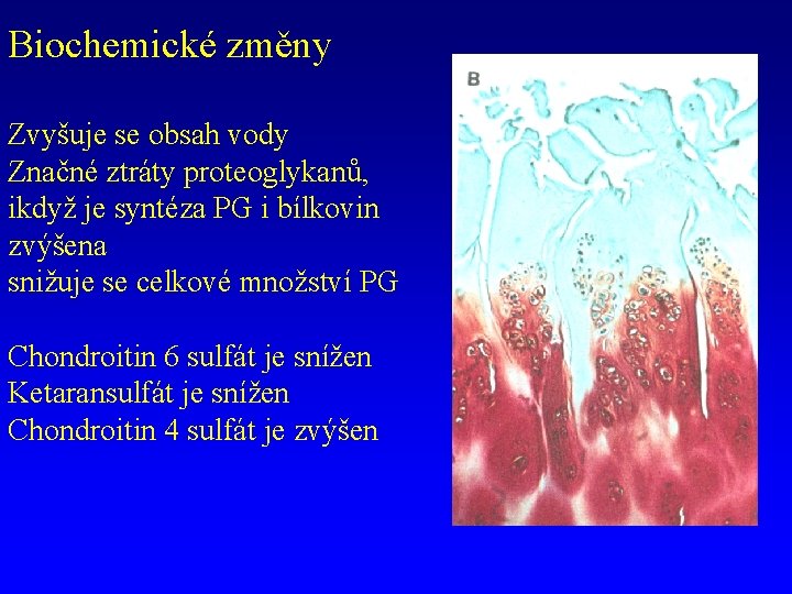 Biochemické změny Zvyšuje se obsah vody Značné ztráty proteoglykanů, ikdyž je syntéza PG i