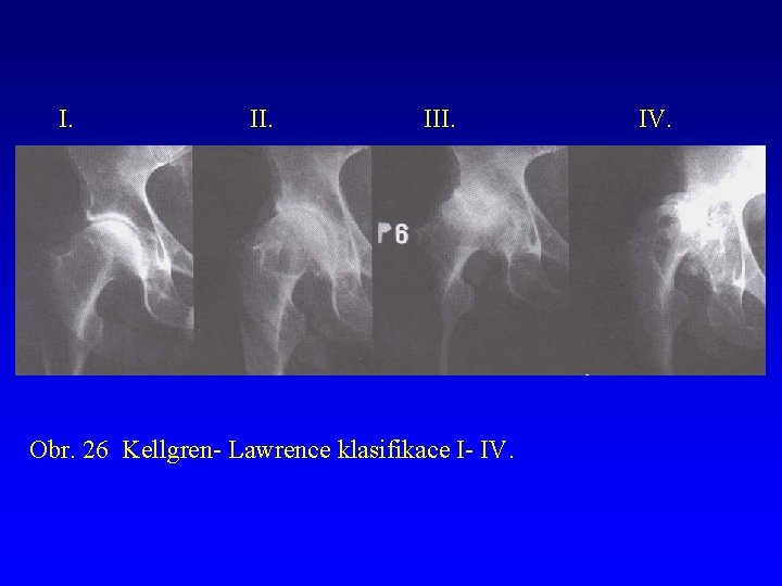 I. III. Obr. 26 Kellgren- Lawrence klasifikace I- IV. 