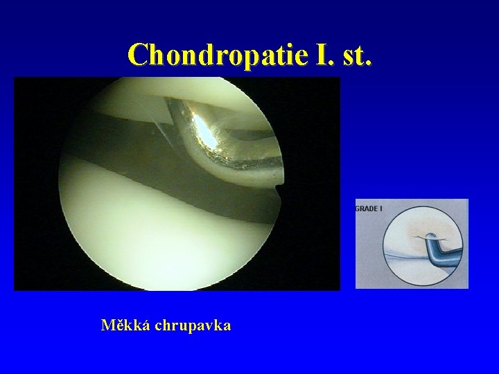 Chondropatie I. st. Měkká chrupavka 