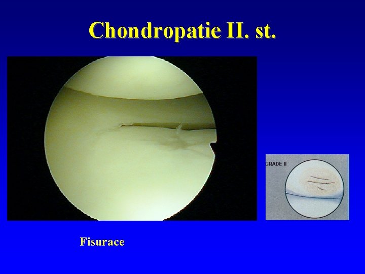 Chondropatie II. st. Fisurace 