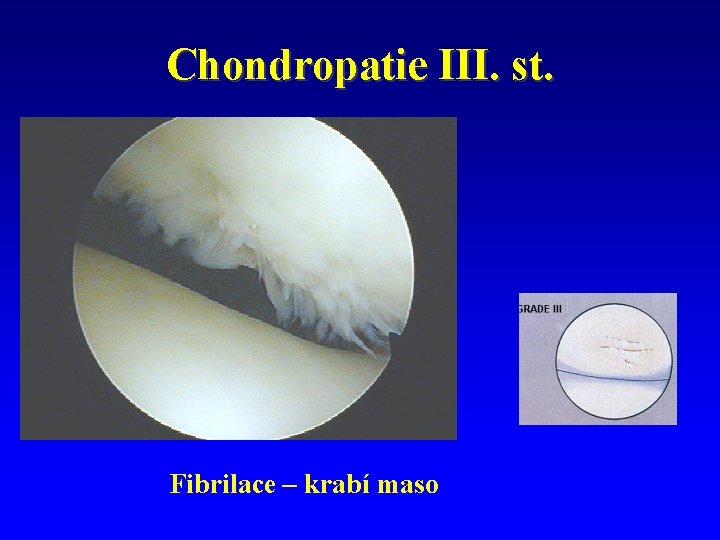 Chondropatie III. st. Fibrilace – krabí maso 