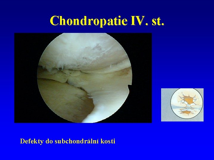 Chondropatie IV. st. Defekty do subchondrální kosti 