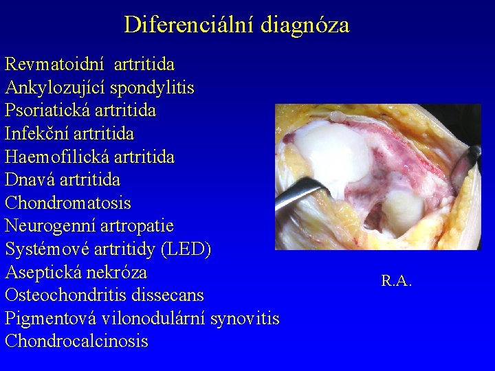 Diferenciální diagnóza Revmatoidní artritida Ankylozující spondylitis Psoriatická artritida Infekční artritida Haemofilická artritida Dnavá artritida