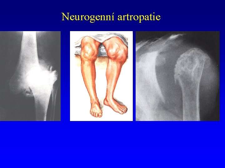 Neurogenní artropatie 