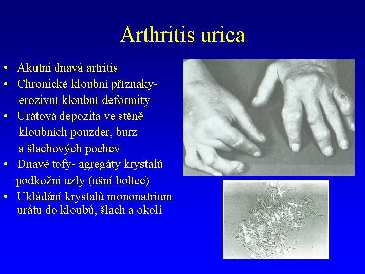 Arthritis urica • Akutní dnavá artritis • Chronické kloubní příznakyerozivní kloubní deformity • Urátová