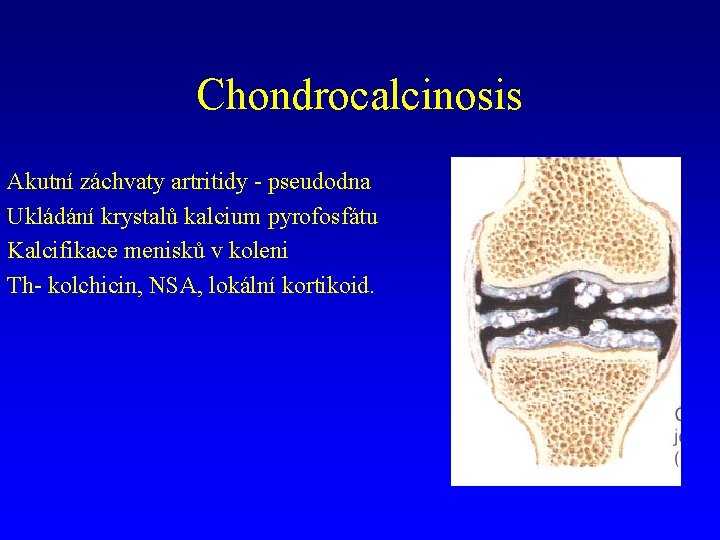 Chondrocalcinosis Akutní záchvaty artritidy - pseudodna Ukládání krystalů kalcium pyrofosfátu Kalcifikace menisků v koleni