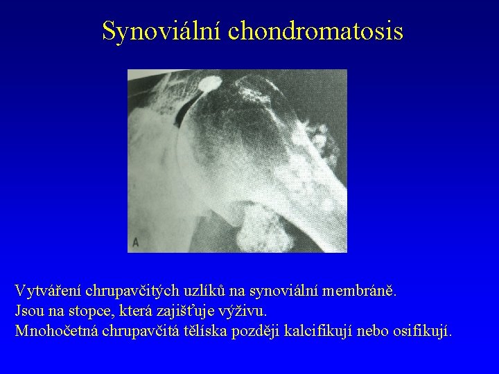 Synoviální chondromatosis Vytváření chrupavčitých uzlíků na synoviální membráně. Jsou na stopce, která zajišťuje výživu.