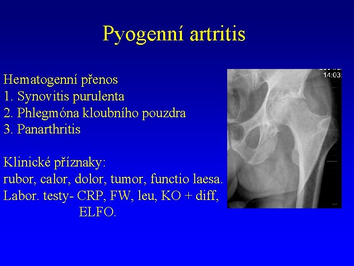 Pyogenní artritis Hematogenní přenos 1. Synovitis purulenta 2. Phlegmóna kloubního pouzdra 3. Panarthritis Klinické