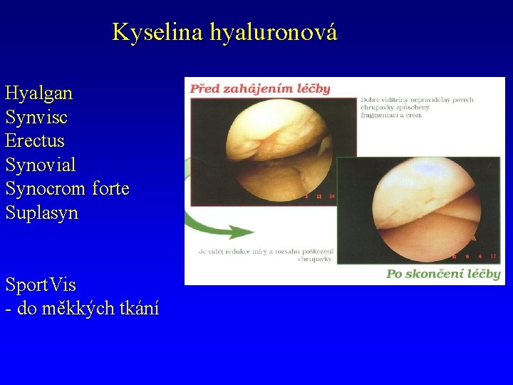 Kyselina hyaluronová Hyalgan Synvisc Erectus Synovial Synocrom forte Suplasyn Sport. Vis - do měkkých