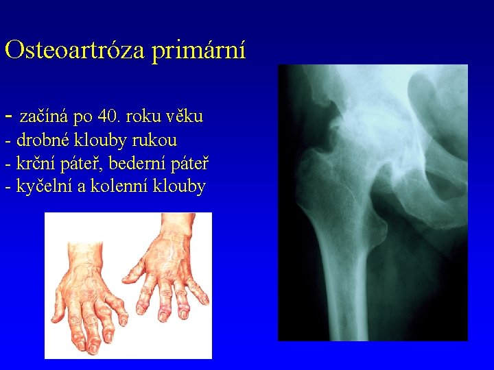 Osteoartróza primární - začíná po 40. roku věku - drobné klouby rukou - krční