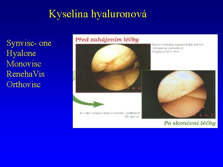 Kyselina hyaluronová Synvisc- one Hyalone Monovisc Reneha. Vis Orthovisc 