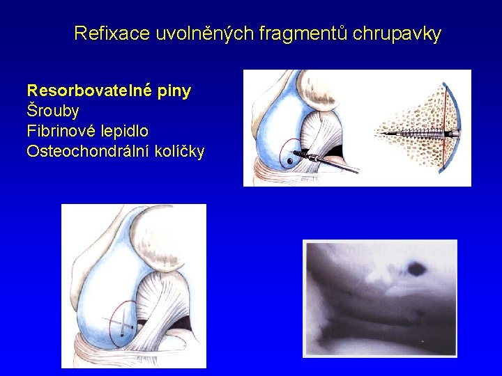 Refixace uvolněných fragmentů chrupavky Resorbovatelné piny Šrouby Fibrinové lepidlo Osteochondrální kolíčky 