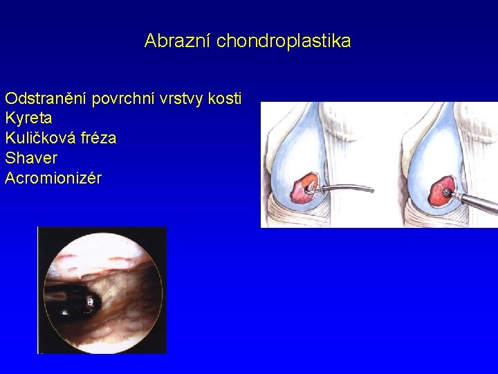 Abrazní chondroplastika Odstranění povrchní vrstvy kosti Kyreta Kuličková fréza Shaver Acromionizér 