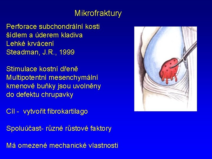 Mikrofraktury Perforace subchondrální kosti šídlem a úderem kladiva Lehké krvácení Steadman, J. R. ,