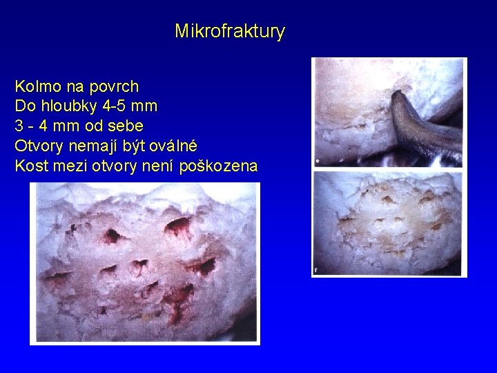 Mikrofraktury Kolmo na povrch Do hloubky 4 -5 mm 3 - 4 mm od