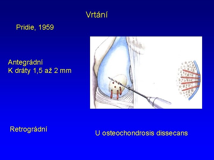 Vrtání Pridie, 1959 Antegrádní K dráty 1, 5 až 2 mm Retrográdní U osteochondrosis