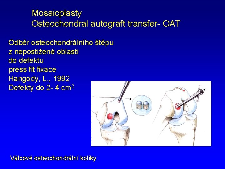 Mosaicplasty Osteochondral autograft transfer- OAT Odběr osteochondrálního štěpu z nepostižené oblasti do defektu press