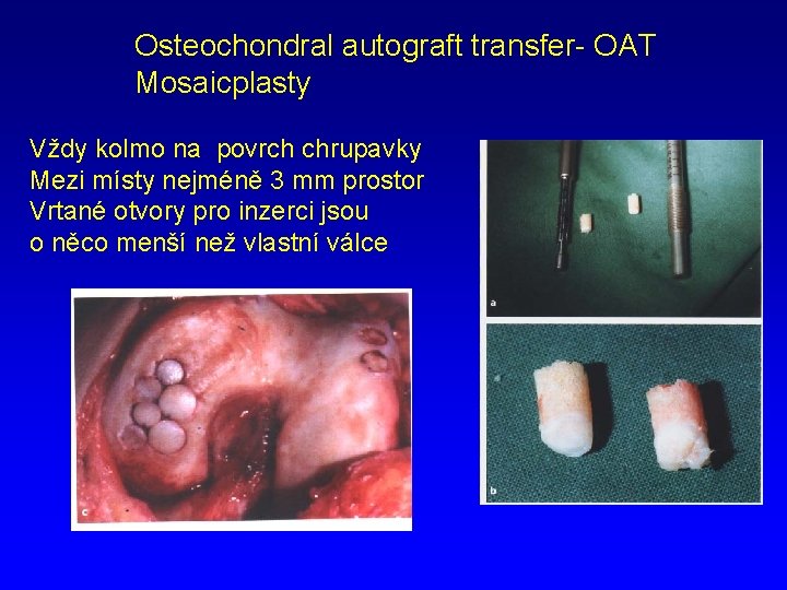 Osteochondral autograft transfer- OAT Mosaicplasty Vždy kolmo na povrch chrupavky Mezi místy nejméně 3