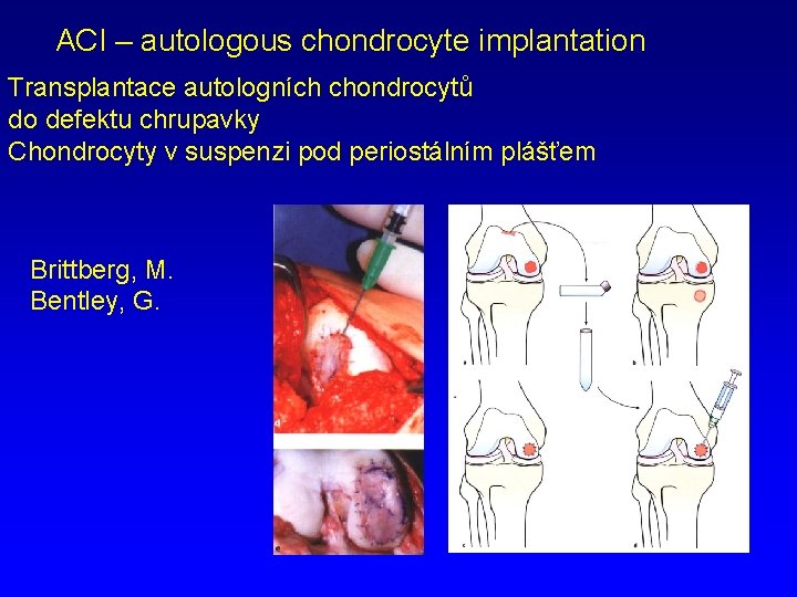 ACI – autologous chondrocyte implantation Transplantace autologních chondrocytů do defektu chrupavky Chondrocyty v suspenzi