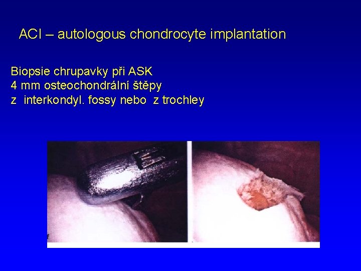 ACI – autologous chondrocyte implantation Biopsie chrupavky při ASK 4 mm osteochondrální štěpy z