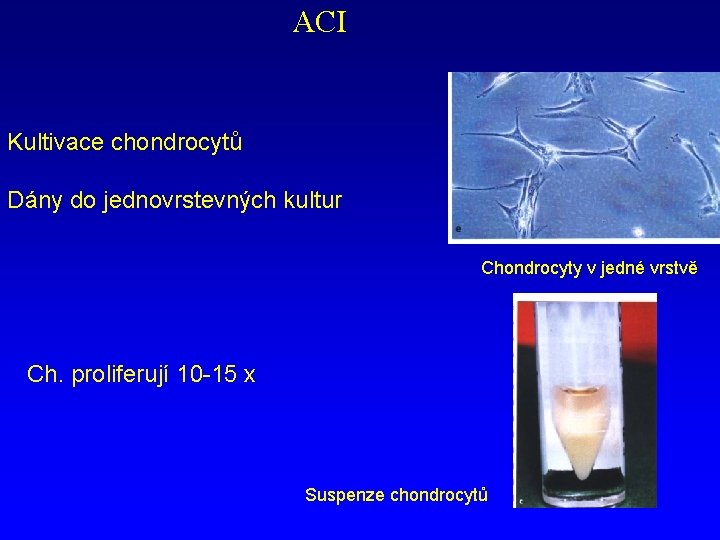 ACI Kultivace chondrocytů Dány do jednovrstevných kultur Chondrocyty v jedné vrstvě Ch. proliferují 10