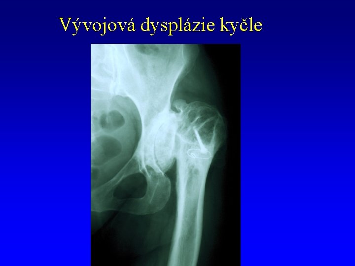 Vývojová dysplázie kyčle 