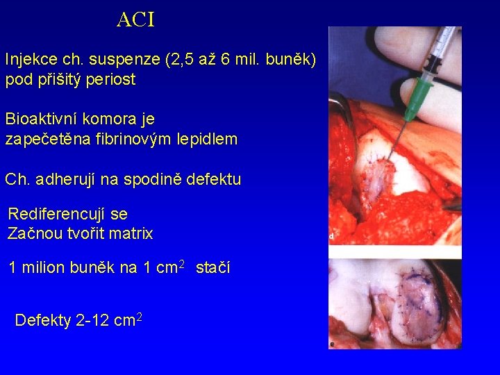 ACI Injekce ch. suspenze (2, 5 až 6 mil. buněk) pod přišitý periost Bioaktivní