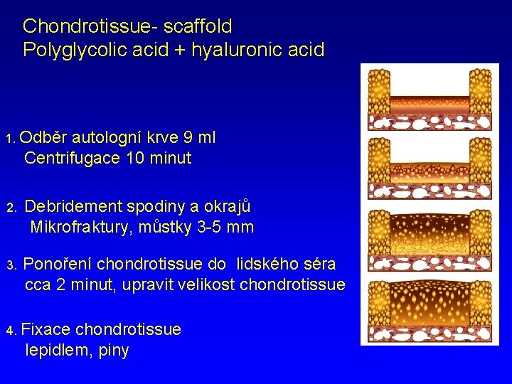 Chondrotissue- scaffold Polyglycolic acid + hyaluronic acid 1. Odběr autologní krve 9 ml Centrifugace