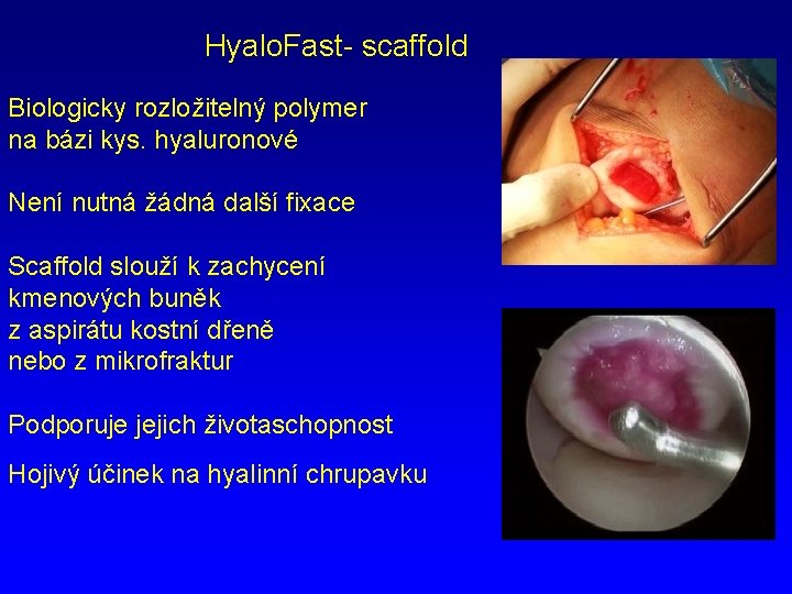 Hyalo. Fast- scaffold Biologicky rozložitelný polymer na bázi kys. hyaluronové Není nutná žádná další