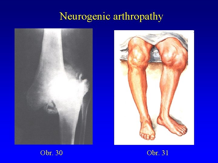 Neurogenic arthropathy Obr. 30 Obr. 31 