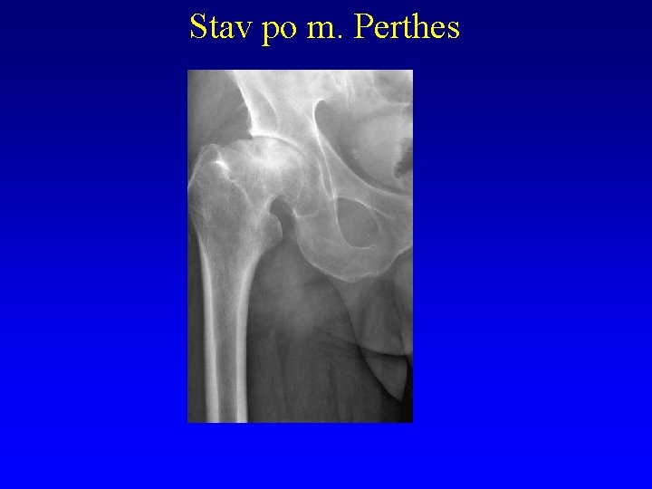 Stav po m. Perthes 