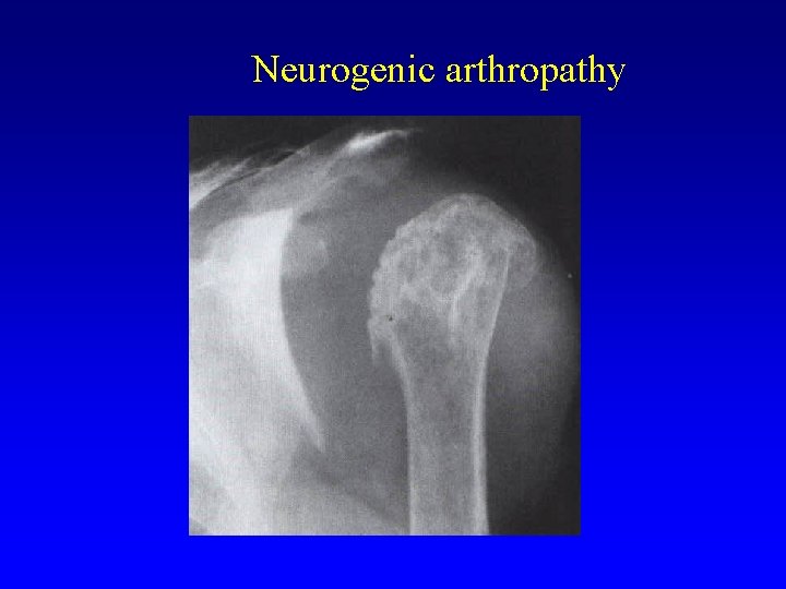 Neurogenic arthropathy 