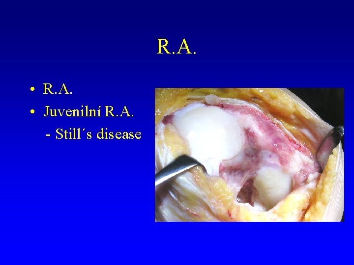 R. A. • Juvenilní R. A. - Still´s disease 
