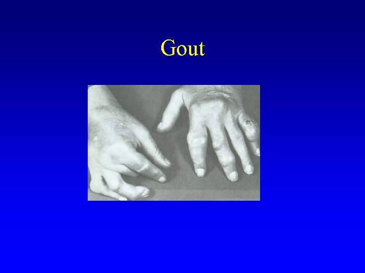 Gout 