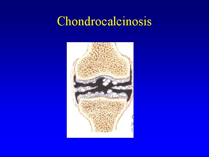 Chondrocalcinosis 