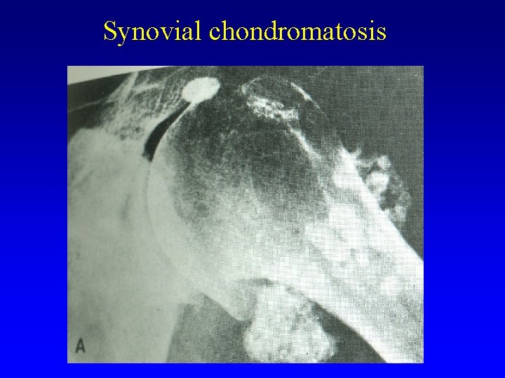 Synovial chondromatosis 