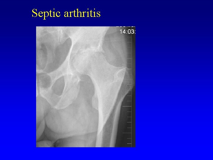 Septic arthritis 