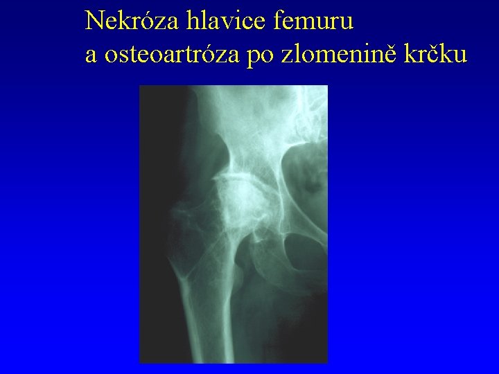 Nekróza hlavice femuru a osteoartróza po zlomenině krčku 