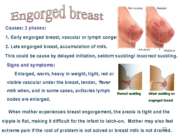 Causes: 2 phases: 1. Early engorged breast, vascular or lymph congestion. 2. Late engorged