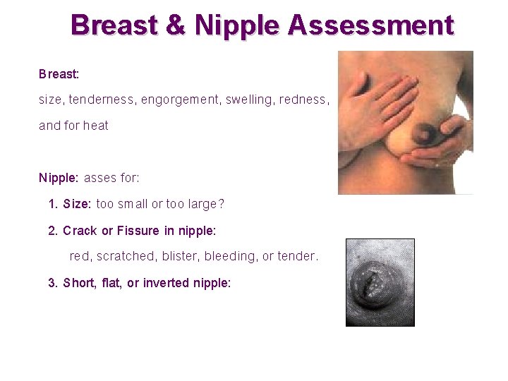 Breast & Nipple Assessment Breast: size, tenderness, engorgement, swelling, redness, and for heat Nipple: