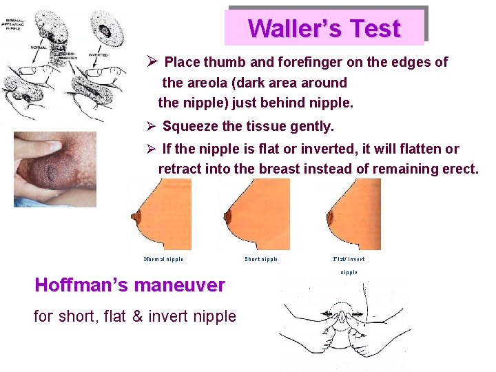 Waller’s Test Ø Place thumb and forefinger on the edges of the areola (dark