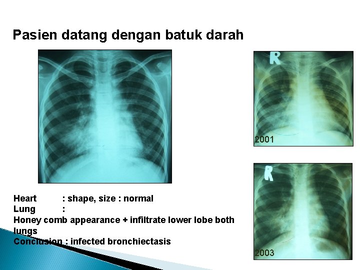 Pasien datang dengan batuk darah 2001 Heart : shape, size : normal Lung :